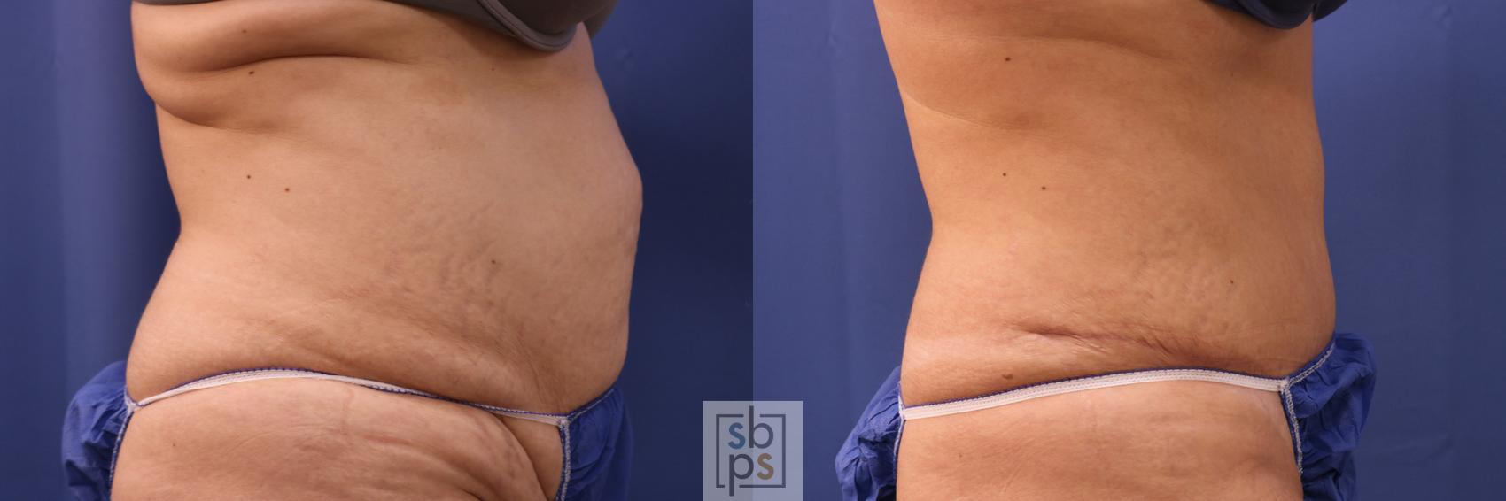 Before & After Tummy Tuck Case 320 View #5 View in Torrance & Los Angeles, CA, CA