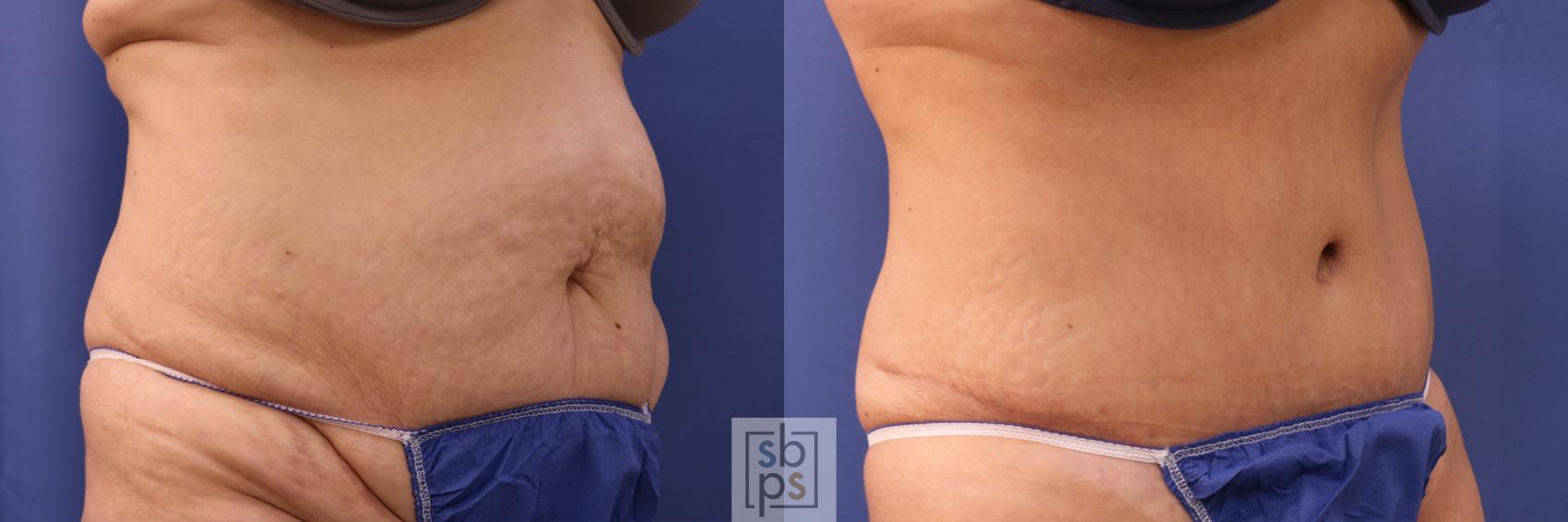 Before & After Tummy Tuck Case 320 View #6 View in Torrance & Los Angeles, CA, CA