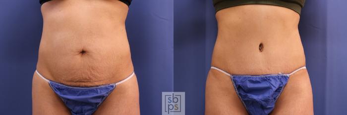 Before & After Tummy Tuck Case 321 View #1 View in Torrance, CA