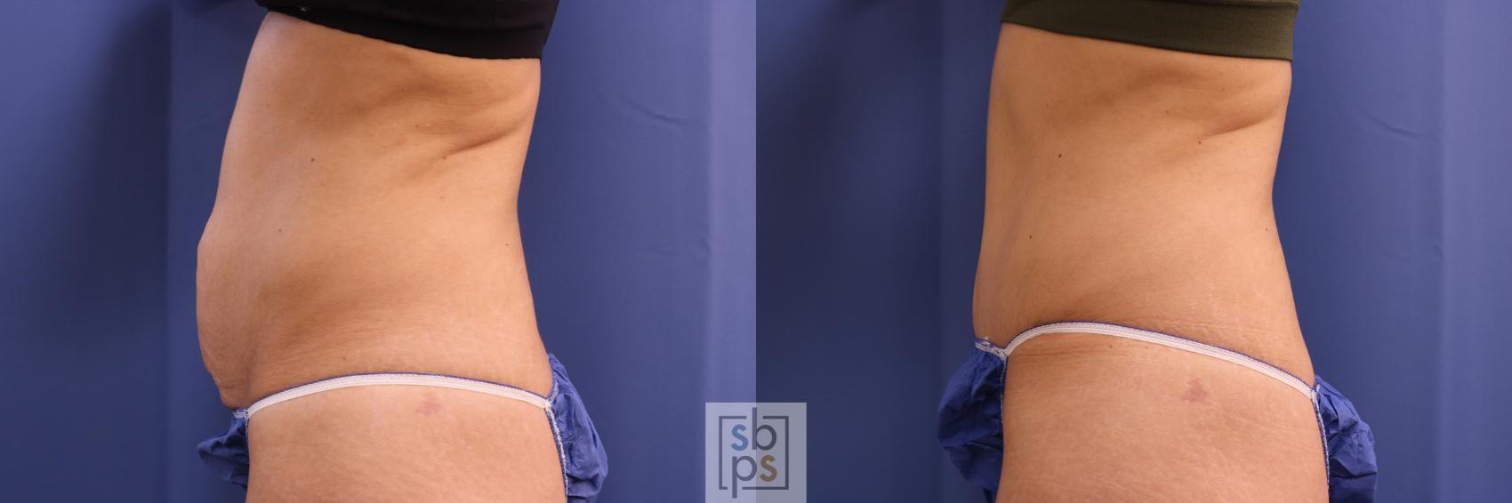 Before & After Tummy Tuck Case 321 View #2 View in Torrance & Los Angeles, CA, CA
