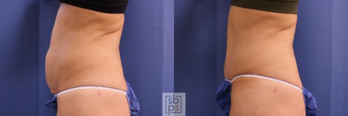 Before & After Tummy Tuck Case 321 View #2 View in Torrance, CA