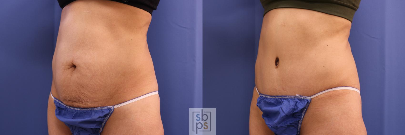 Before & After Tummy Tuck Case 321 View #3 View in Torrance & Los Angeles, CA, CA