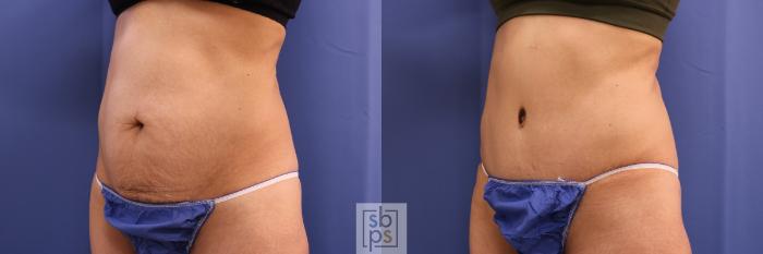 Before & After Tummy Tuck Case 321 View #3 View in Torrance, CA
