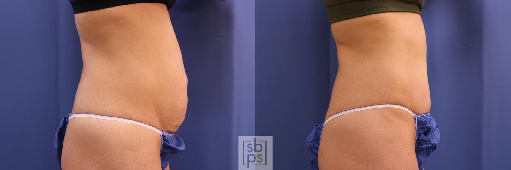Before & After Tummy Tuck Case 321 View #4 View in Torrance & Los Angeles, CA, CA