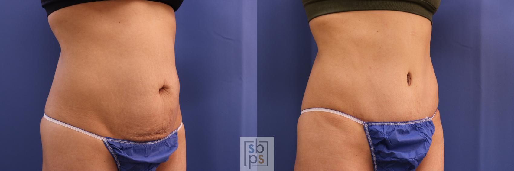 Before & After Tummy Tuck Case 321 View #5 View in Torrance & Los Angeles, CA, CA