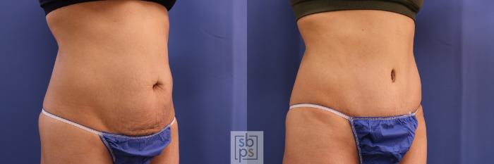 Before & After Tummy Tuck Case 321 View #5 View in Torrance, CA