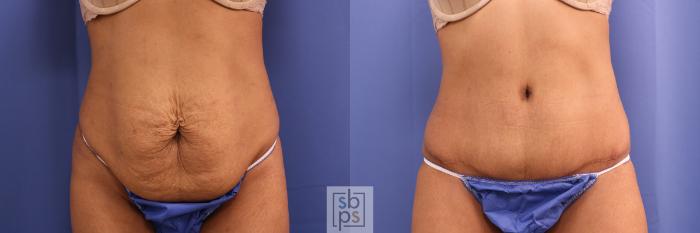 Before & After Tummy Tuck Case 341 View #1 View in Torrance, CA