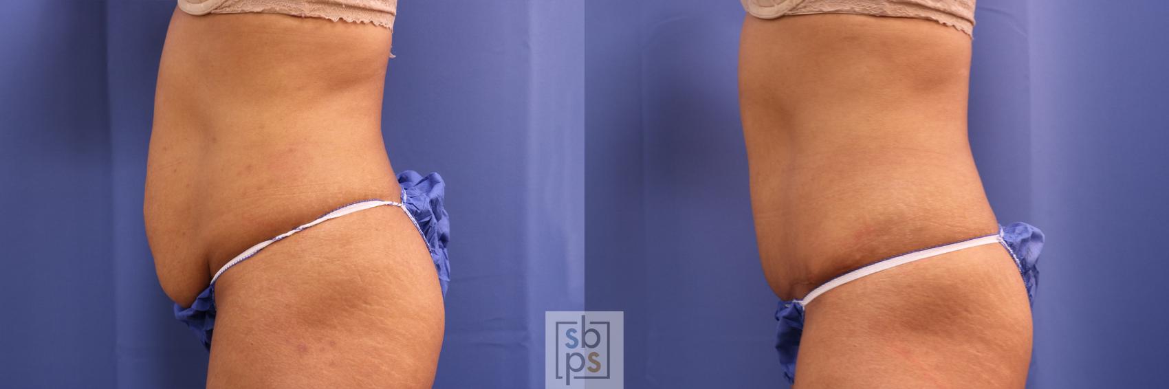 Before & After Tummy Tuck Case 341 View #2 View in Torrance & Los Angeles, CA, CA