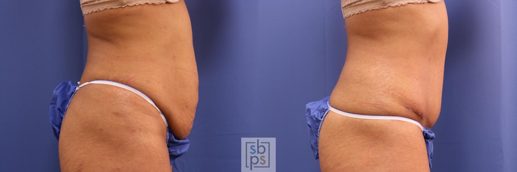 Before & After Tummy Tuck Case 341 View #4 View in Torrance & Los Angeles, CA, CA