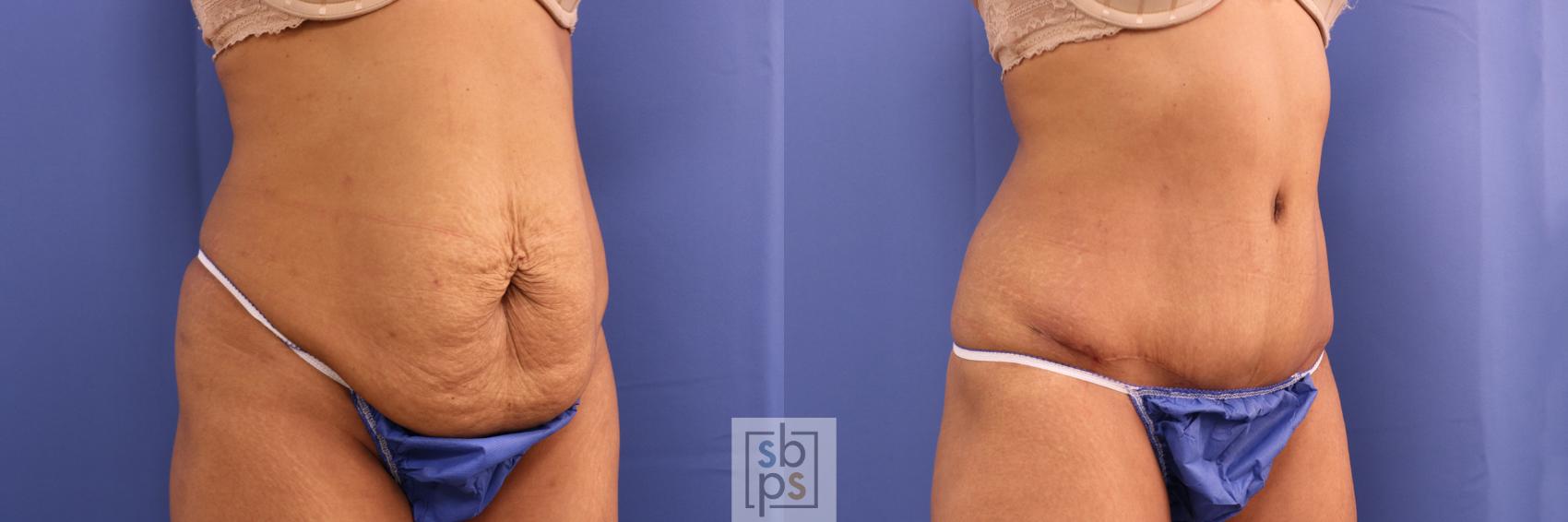 Before & After Tummy Tuck Case 341 View #5 View in Torrance & Los Angeles, CA, CA