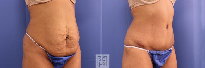 Before & After Tummy Tuck Case 341 View #5 View in Torrance, CA