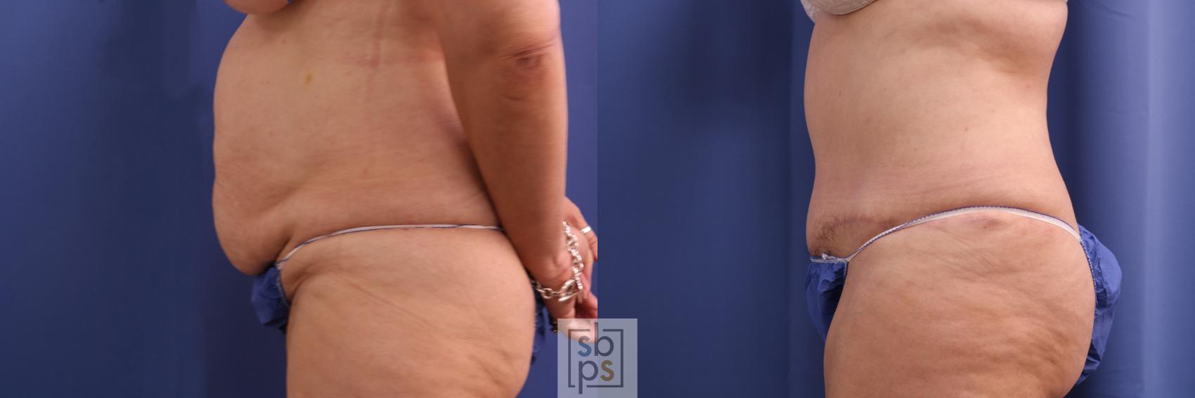 Before & After Liposuction Case 347 View #2 View in Torrance, CA