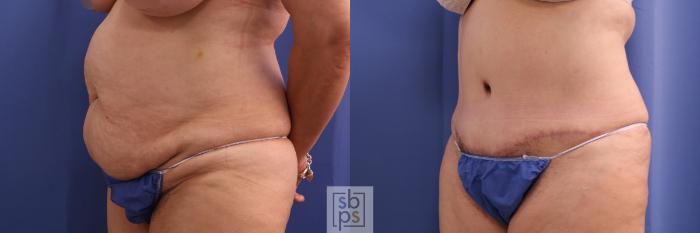 Before & After Tummy Tuck Case 347 View #3 View in Torrance, CA