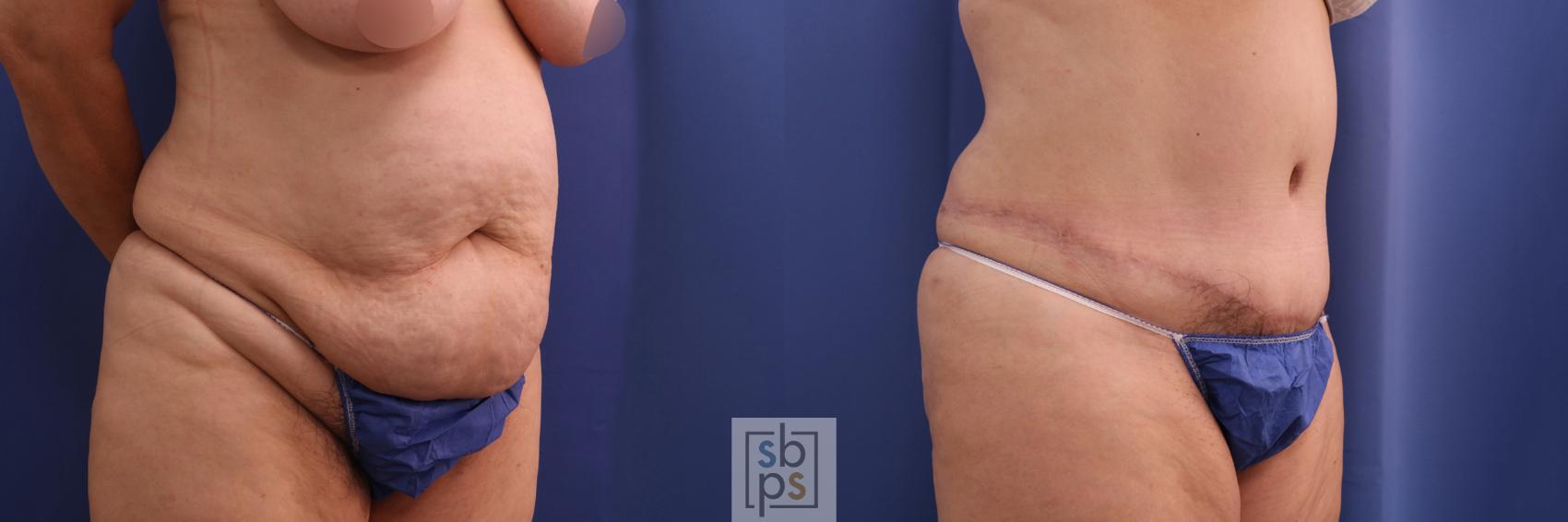 Before & After Liposuction Case 347 View #5 View in Torrance, CA