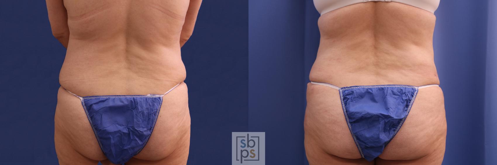 Before & After Liposuction Case 347 View #6 View in Torrance, CA