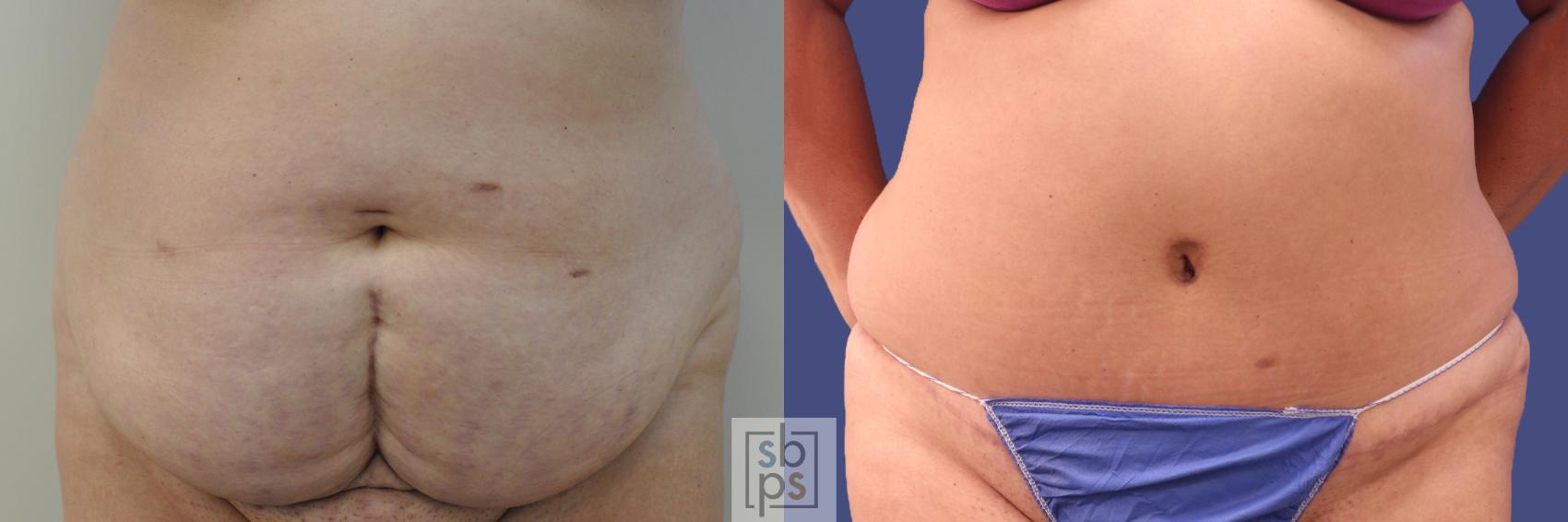 Before & After Tummy Tuck Case 351 View #1 View in Torrance, CA