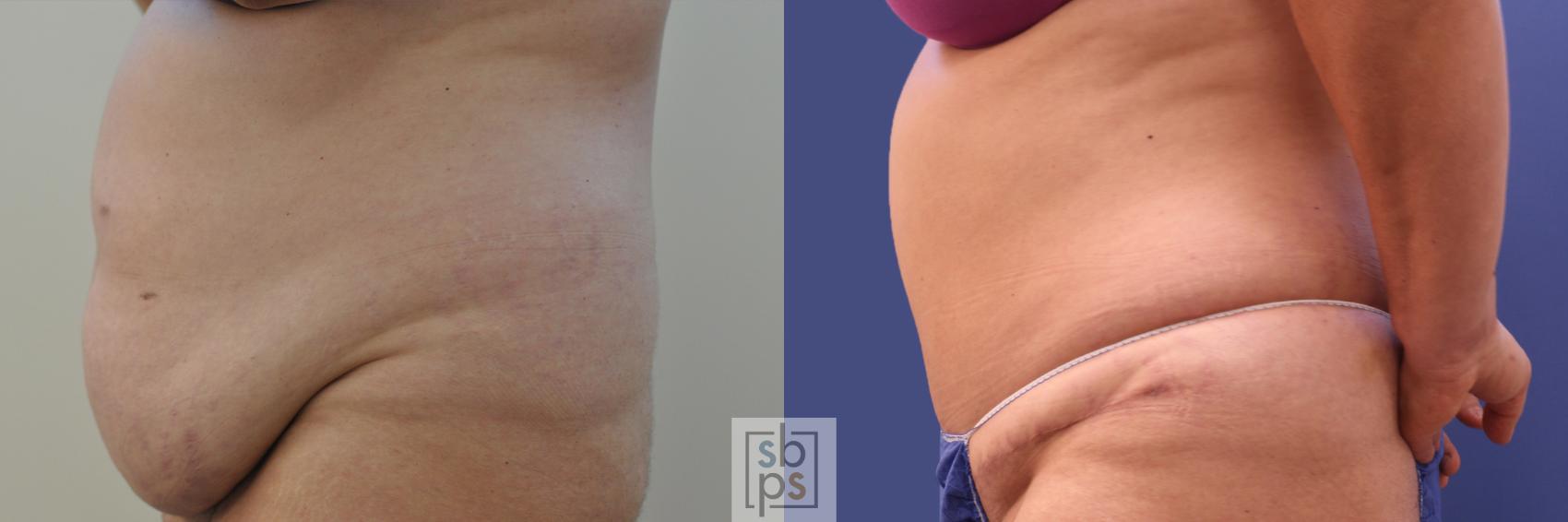 Before & After Tummy Tuck Case 351 View #2 View in Torrance, CA