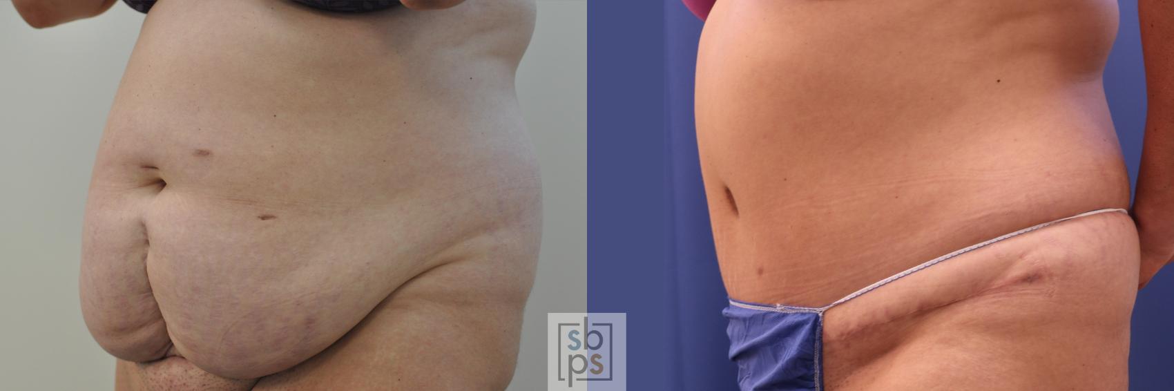 Before & After Tummy Tuck Case 351 View #3 View in Torrance, CA