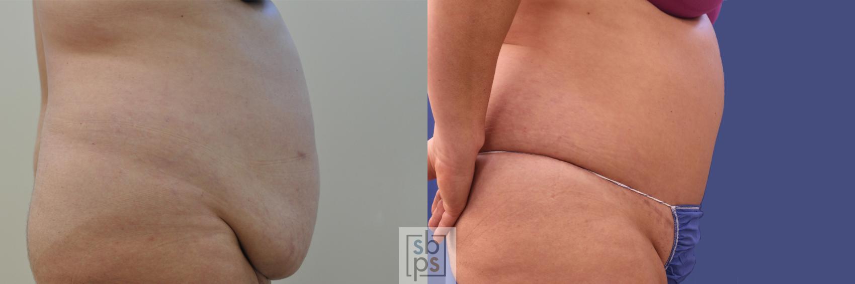 Before & After Tummy Tuck Case 351 View #4 View in Torrance, CA