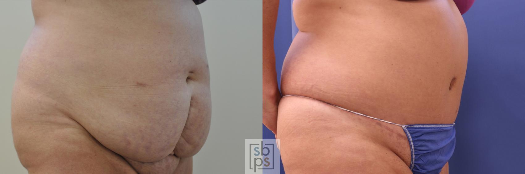 Before & After Tummy Tuck Case 351 View #5 View in Torrance, CA