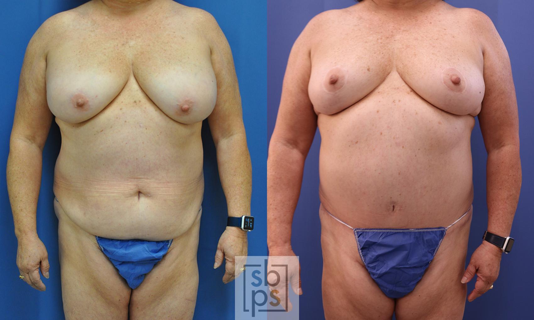 Before & After Tummy Tuck Case 356 View #1 View in Torrance, CA