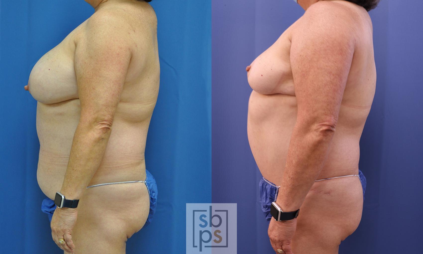 Before & After Tummy Tuck Case 356 View #2 View in Torrance & Los Angeles, CA, CA
