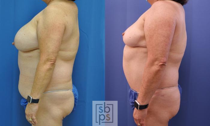 Before & After Tummy Tuck Case 356 View #2 View in Torrance, CA