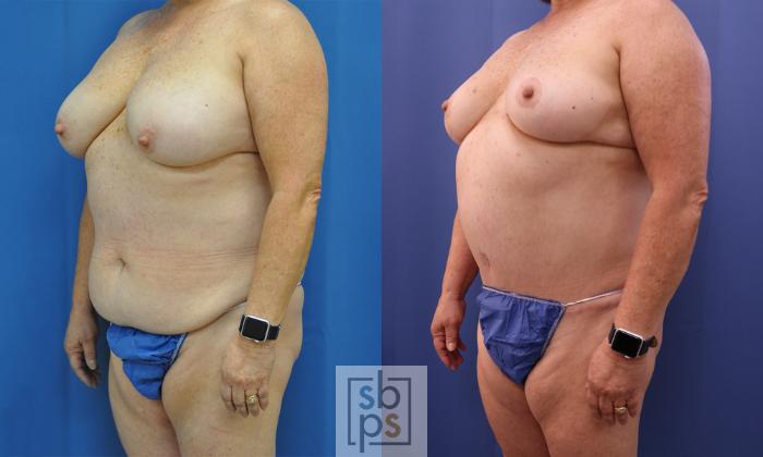 Before & After Tummy Tuck Case 356 View #3 View in Torrance, CA