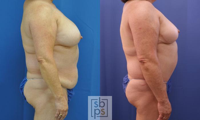 Before & After Tummy Tuck Case 356 View #4 View in Torrance, CA