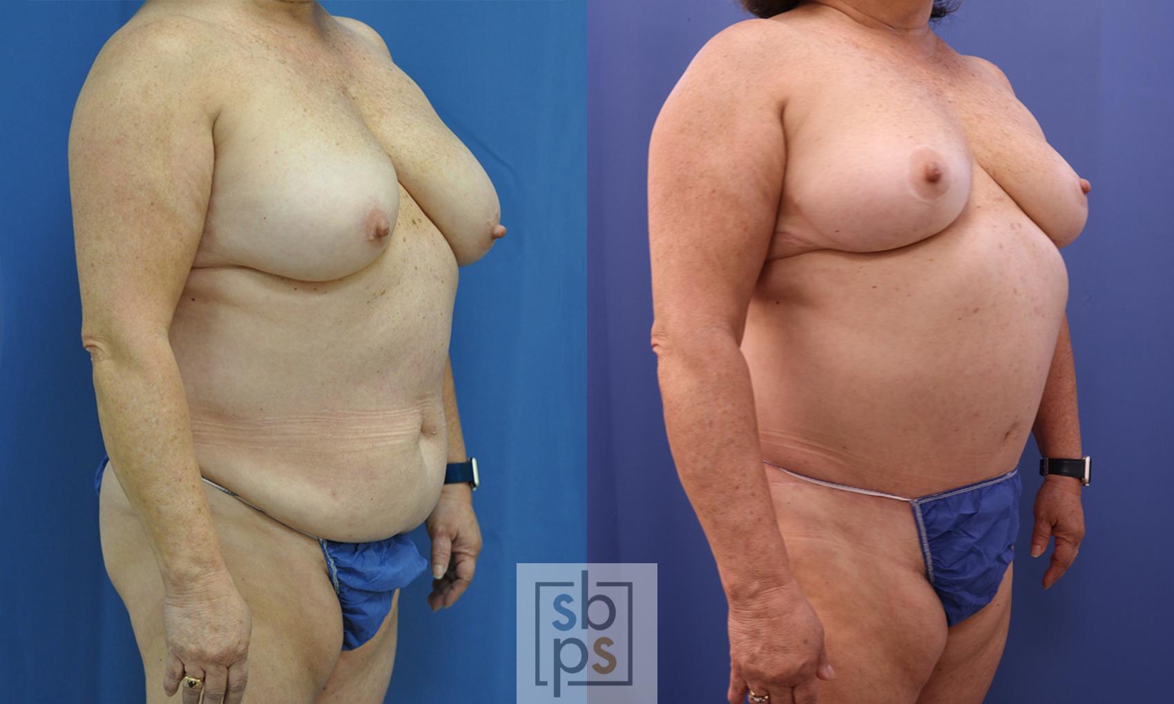 Before & After Tummy Tuck Case 356 View #5 View in Torrance & Los Angeles, CA, CA