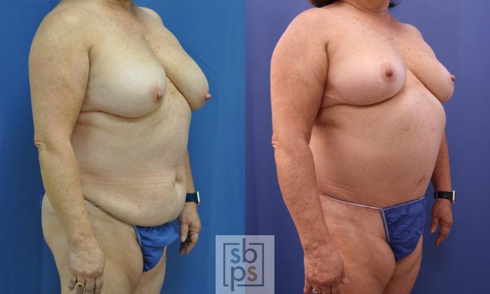 Before & After Tummy Tuck Case 356 View #5 View in Torrance, CA