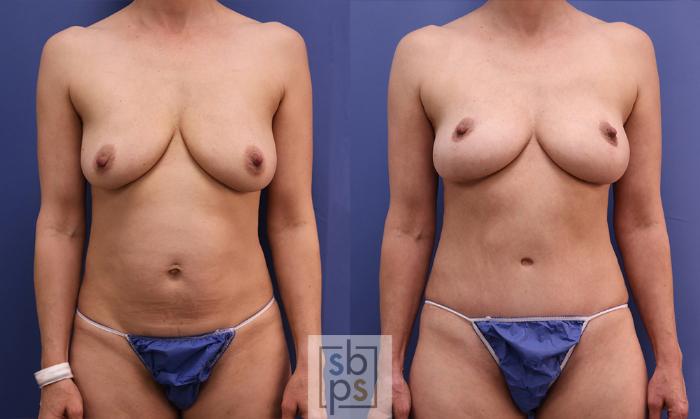 Before & After Tummy Tuck Case 358 View #1 View in Torrance, CA