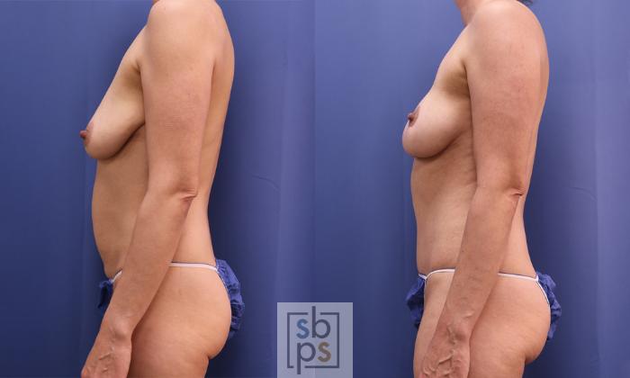 Before & After Breast Reduction Case 358 View #2 View in Torrance, CA