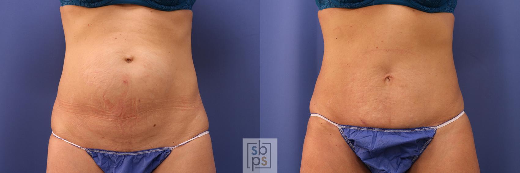 Before & After Tummy Tuck Case 374 View #1 View in Torrance, CA