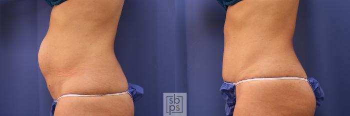Before & After Tummy Tuck Case 374 View #2 View in Torrance, CA