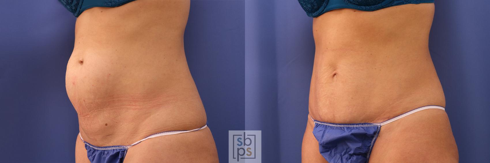 Before & After Tummy Tuck Case 374 View #3 View in Torrance & Los Angeles, CA, CA