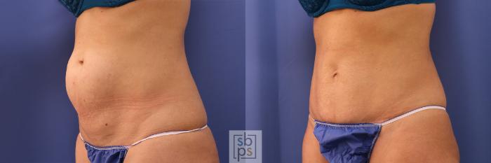 Before & After Tummy Tuck Case 374 View #3 View in Torrance, CA