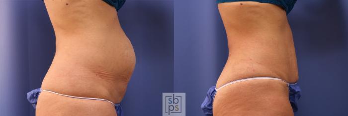 Before & After Tummy Tuck Case 374 View #4 View in Torrance, CA