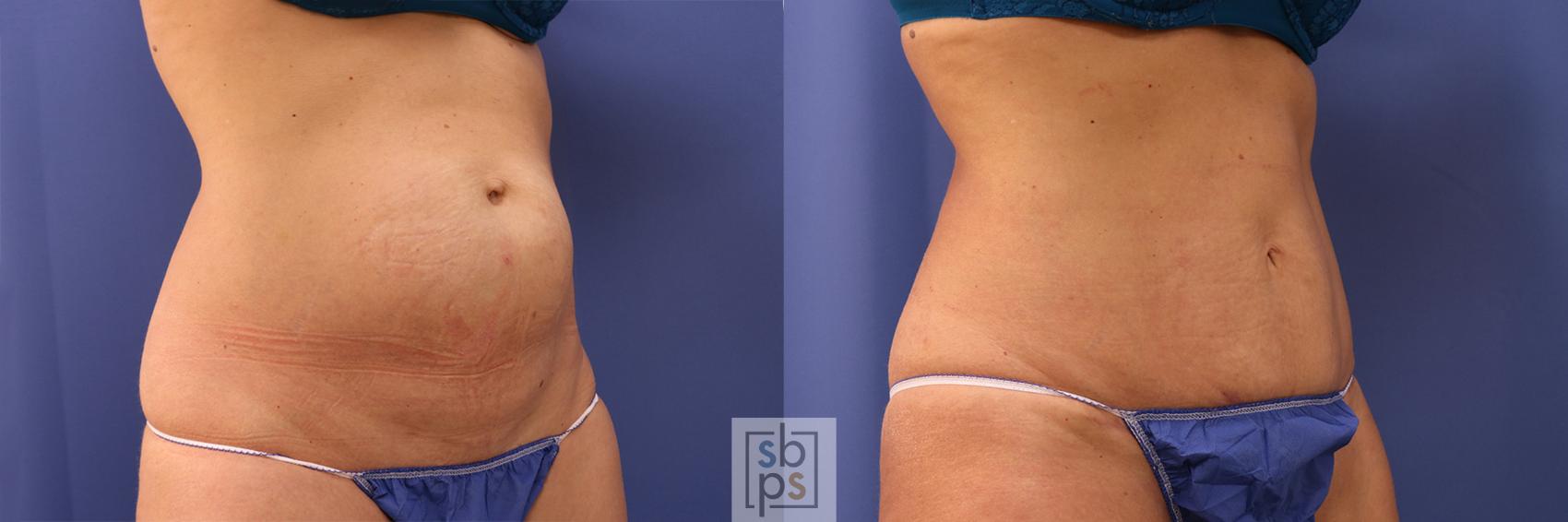 Before & After Tummy Tuck Case 374 View #5 View in Torrance & Los Angeles, CA, CA