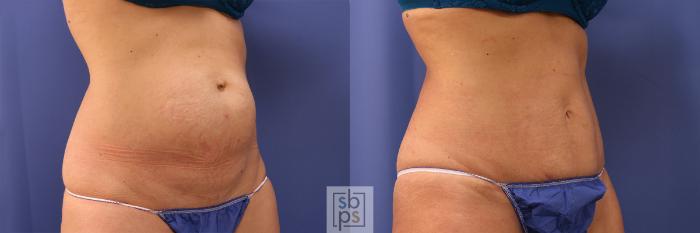 Before & After Tummy Tuck Case 374 View #5 View in Torrance, CA