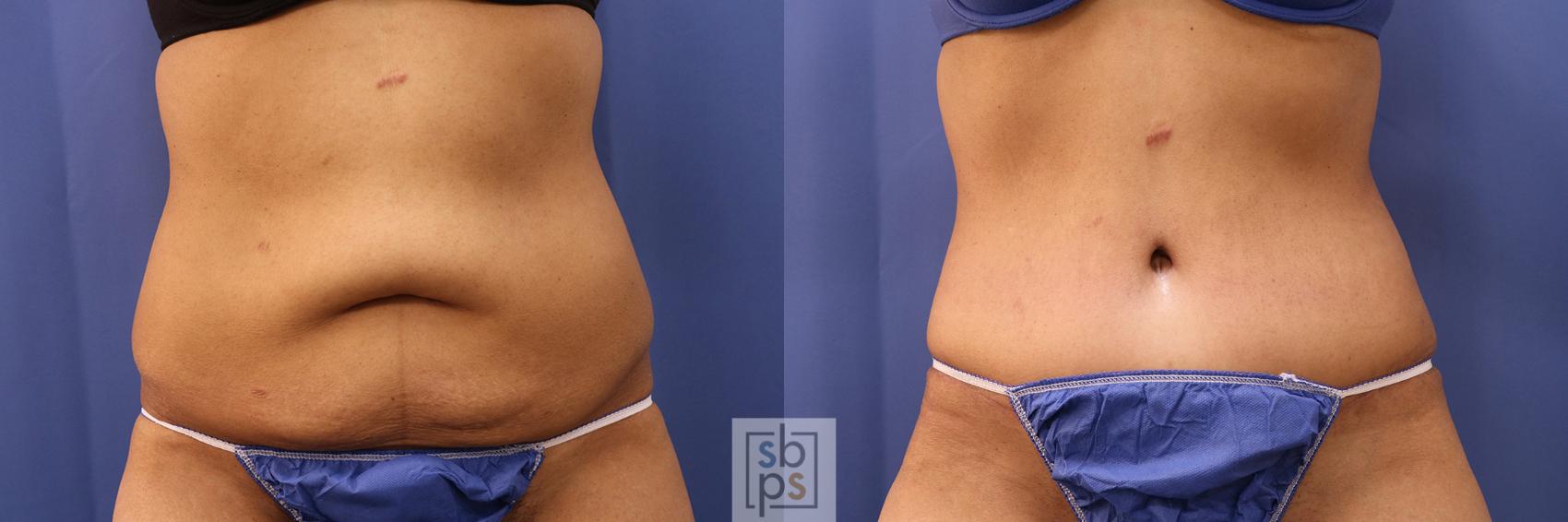 Before & After Tummy Tuck Case 380 View #1 View in Torrance, CA