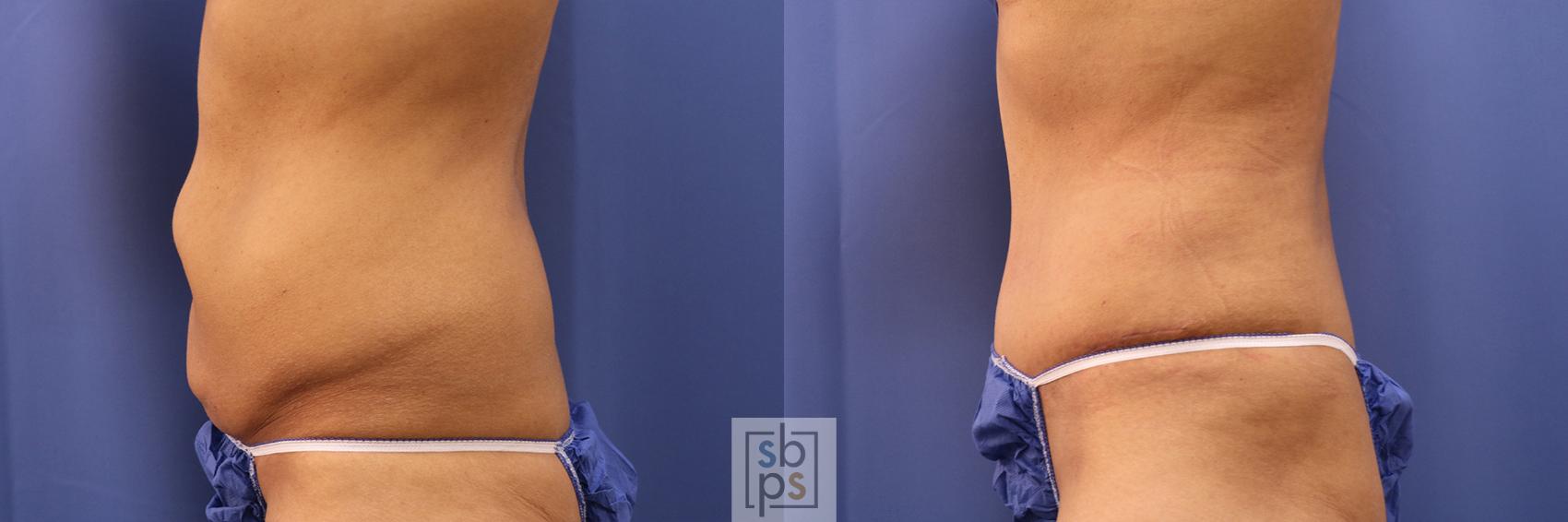Before & After Tummy Tuck Case 380 View #2 View in Torrance & Los Angeles, CA, CA