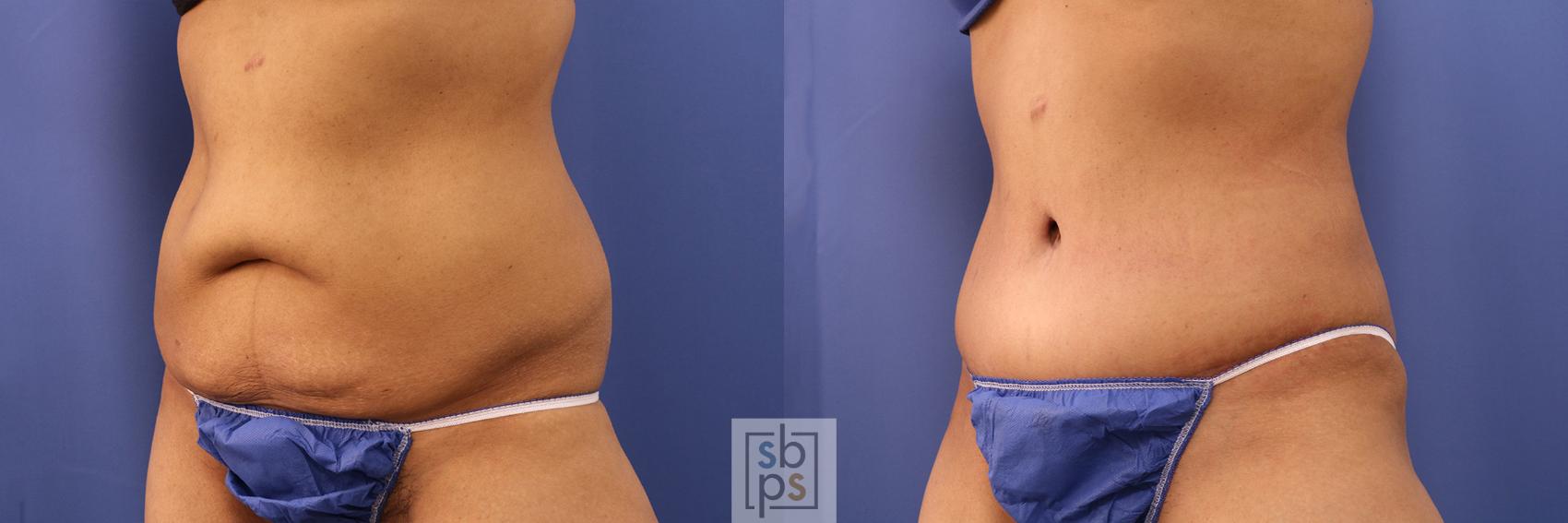 Before & After Tummy Tuck Case 380 View #3 View in Torrance & Los Angeles, CA, CA