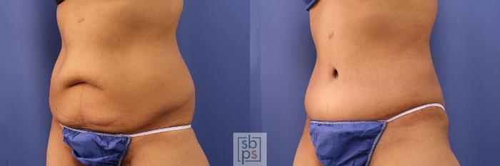 Before & After Tummy Tuck Case 380 View #3 View in Torrance, CA