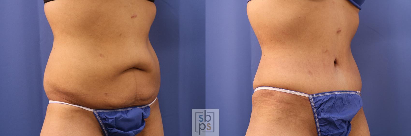Before & After Tummy Tuck Case 380 View #5 View in Torrance & Los Angeles, CA, CA