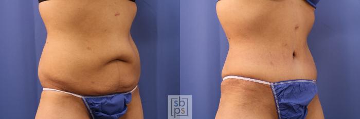 Before & After Tummy Tuck Case 380 View #5 View in Torrance, CA
