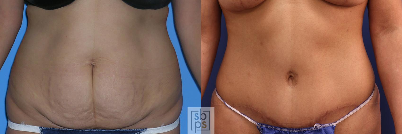 Before & After Tummy Tuck Case 384 Front View in Torrance, CA