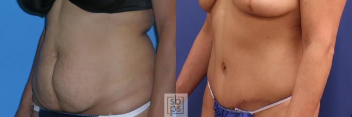 Before & After Tummy Tuck Case 384 Left Oblique View in Torrance, CA