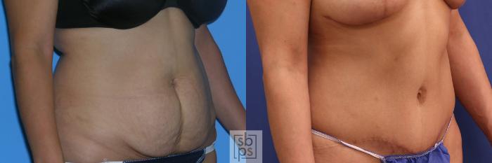 Before & After Tummy Tuck Case 384 Right Oblique View in Torrance, CA