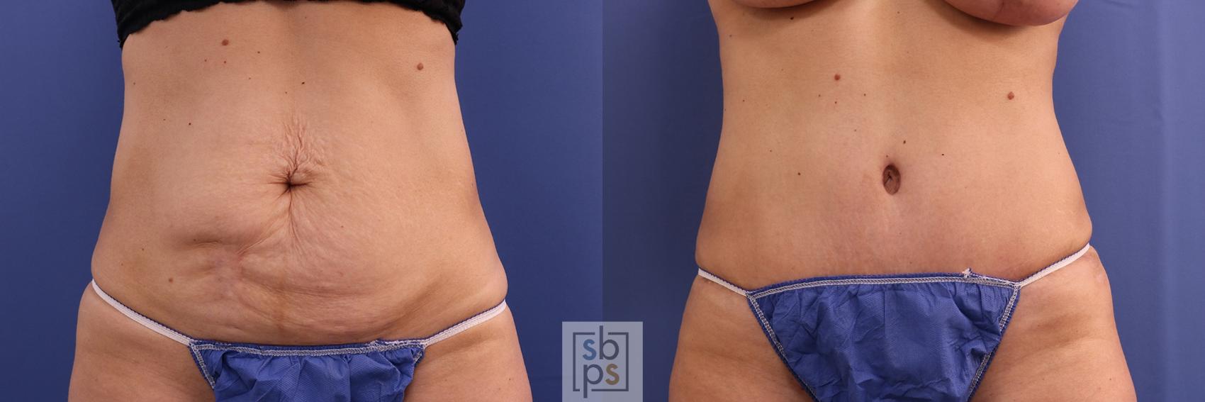 Before & After Tummy Tuck Case 385 Front View in Torrance, CA